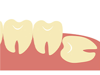 真っすぐ生えていれば、奥歯と同じように抜歯が可能