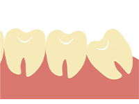 真っすぐ生えていれば、奥歯と同じように抜歯が可能