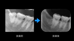 ブログ用症例取り出し.001