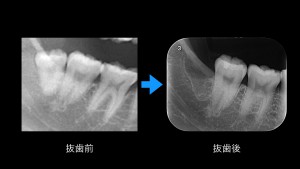 ブログ用症例取り出し.001