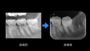 ブログ用症例取り出し.002