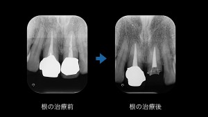 ブログ用症例取り出し.002