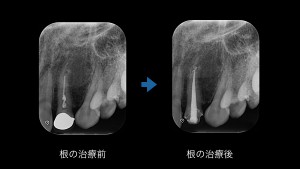 ブログ用症例取り出し.003