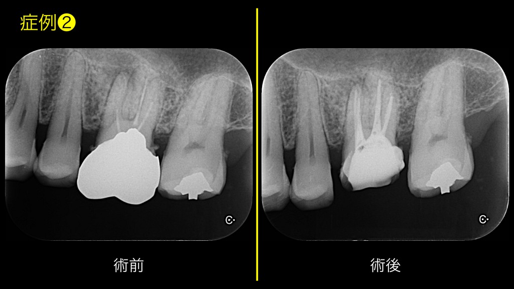 ブログ用症例取り出し.002