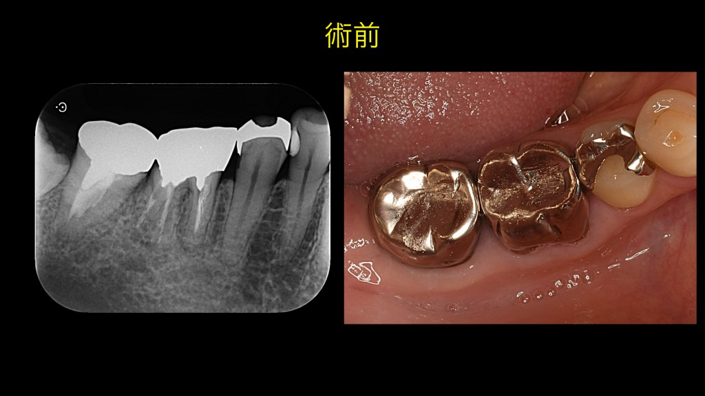 ブログ用症例取り出し.003