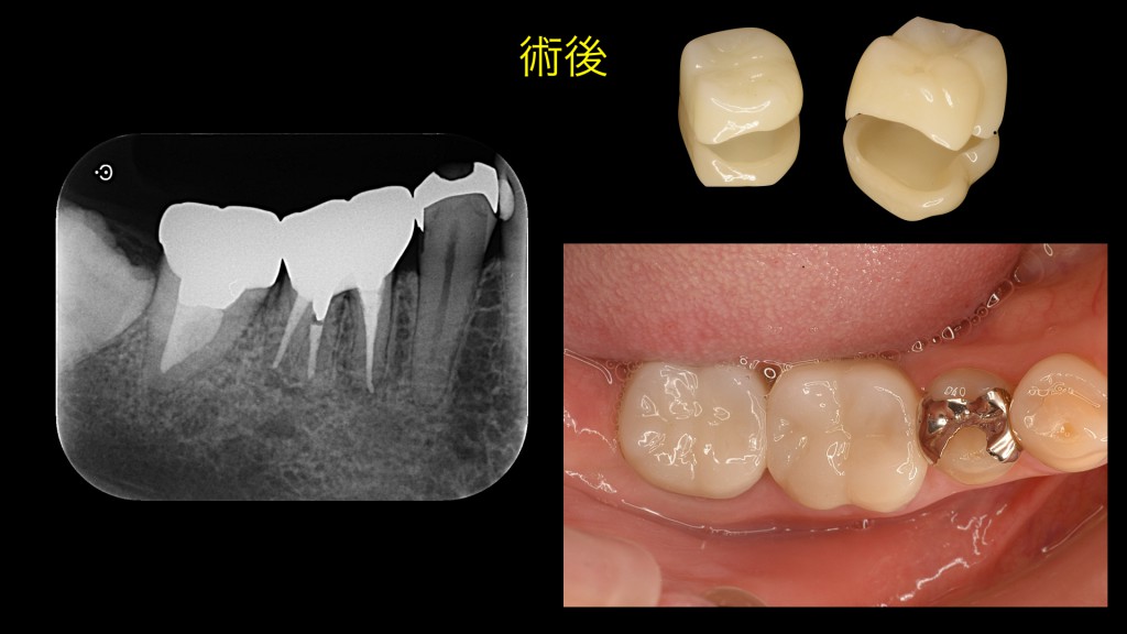 ブログ用症例取り出し.004