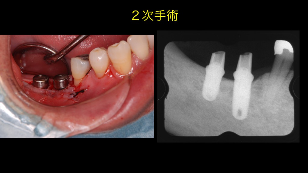 ブログ用症例取り出し.003