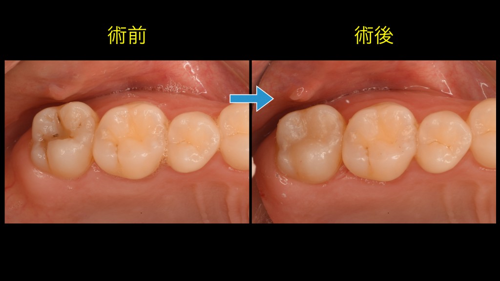 ブログ用症例取り出し.001