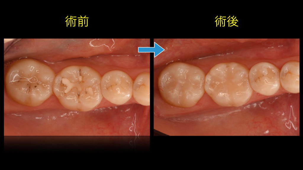 ブログ用症例取り出し.002